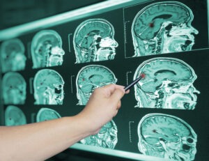 Close,up,hand,doctor,point,brian,scan,image,of,a