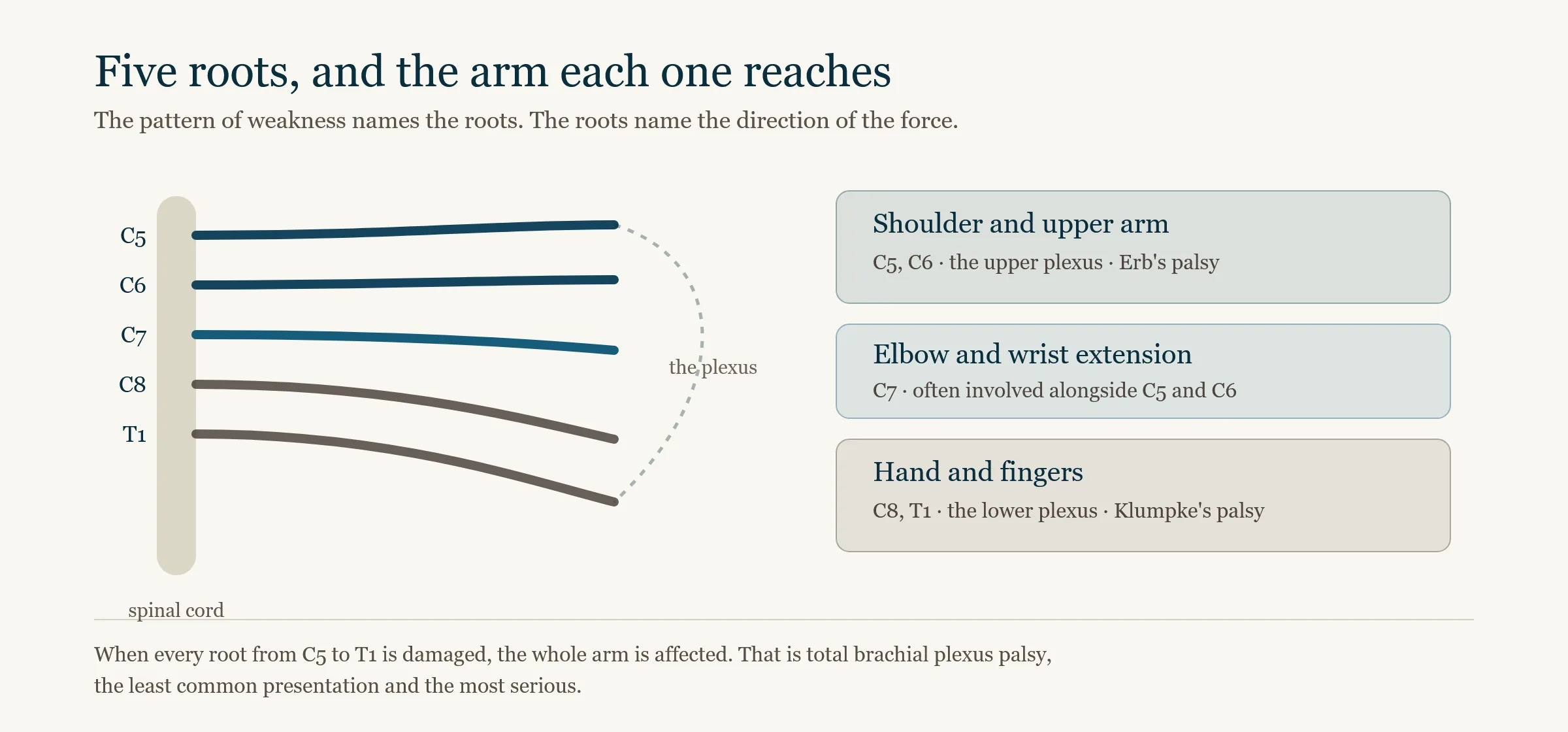 Diagram of the brachial plexus, showing the C5 to T1 nerve roots leaving the spinal cord and branching into the shoulder, upper arm, forearm and hand