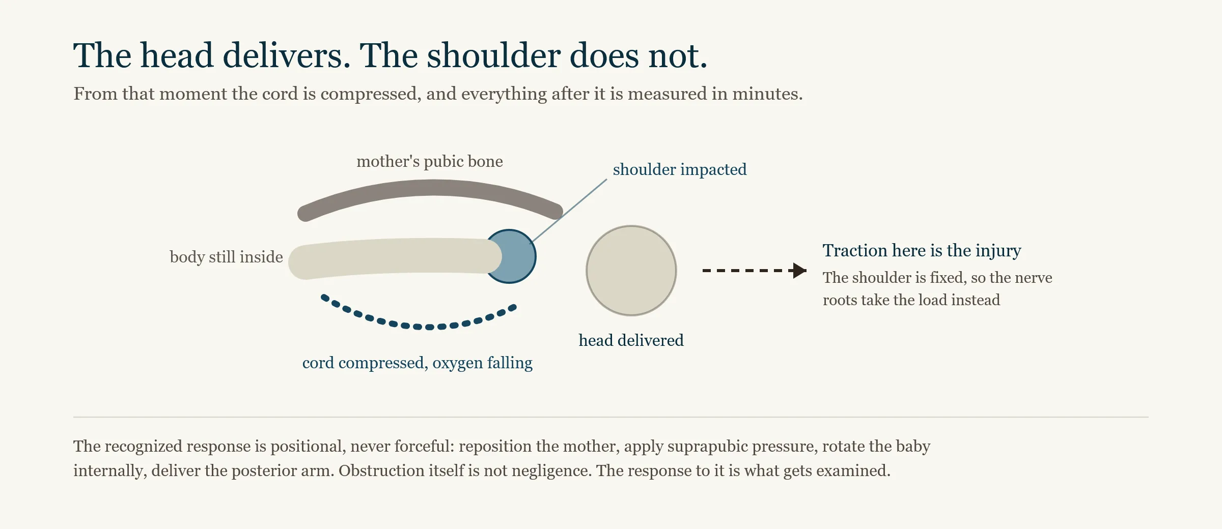 Diagram of the shoulder dystocia mechanism, showing the delivered head, the anterior shoulder impacted behind the mother's pubic bone, and the compressed umbilical cord inside the birth canal